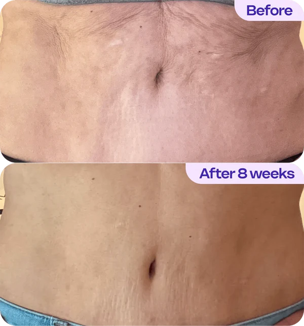 1. Helps Your Belly Skin Look Tighter, Smoother, and More Toned