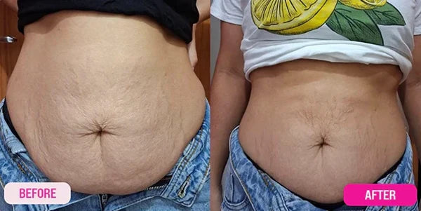 3. Melts Stubborn Fat While Firming Loose Skin