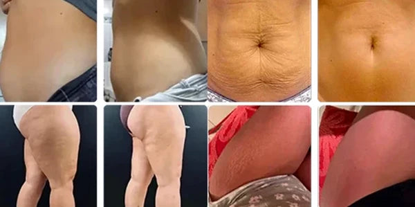 5. Targets the 'Stubborn Zones' Where Diet and Exercise Don't Work — Love Handles, Lower Belly, Inner Thighs