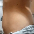 Fades white stretch marks - After
