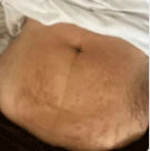 Visibly diminishes the appearance of cellulite - Before