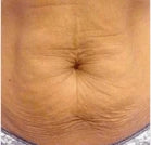 Reduces sagging skin - Before