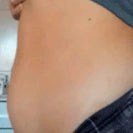 Fades white stretch marks - Before