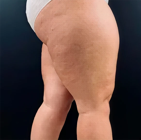 Before - Laura G.
